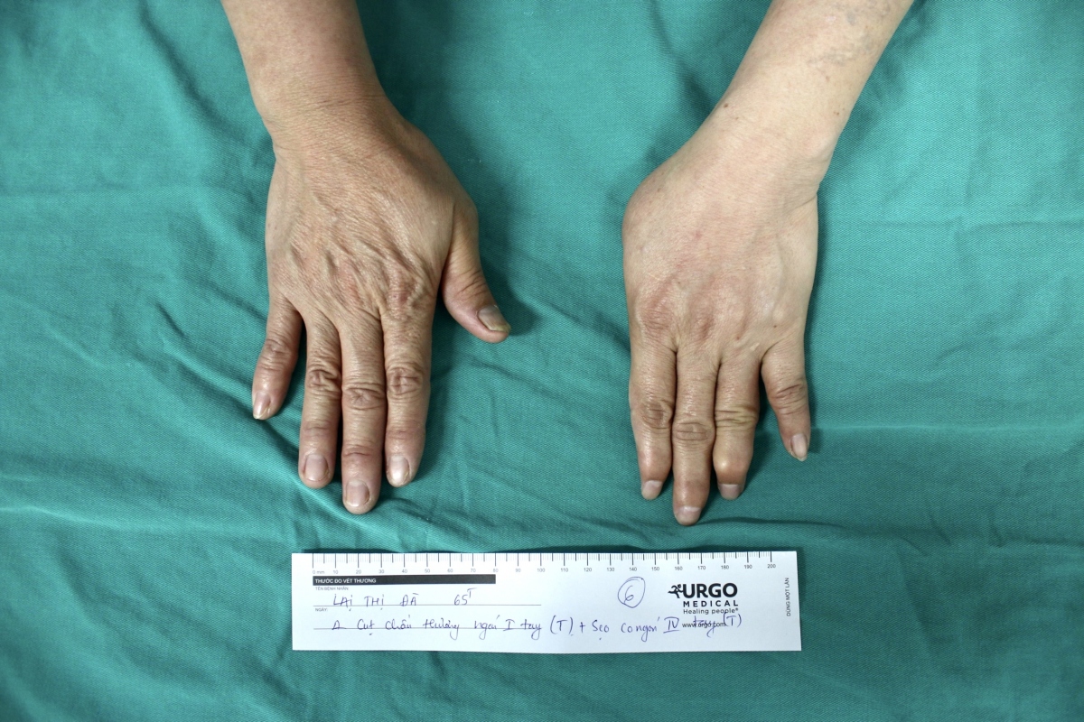 Tái tạo ngón tay cái từ ngón chân cho bệnh nhân bị tai nạn lao động
